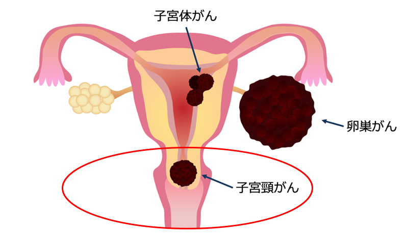 子宮頸がん