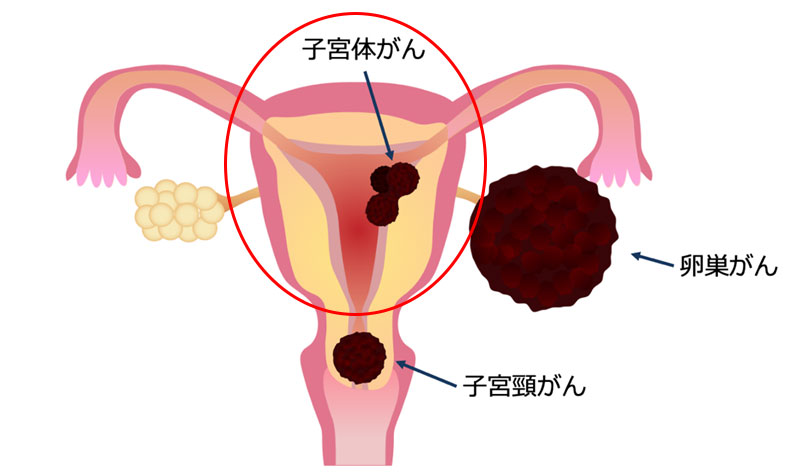 子宮体がん