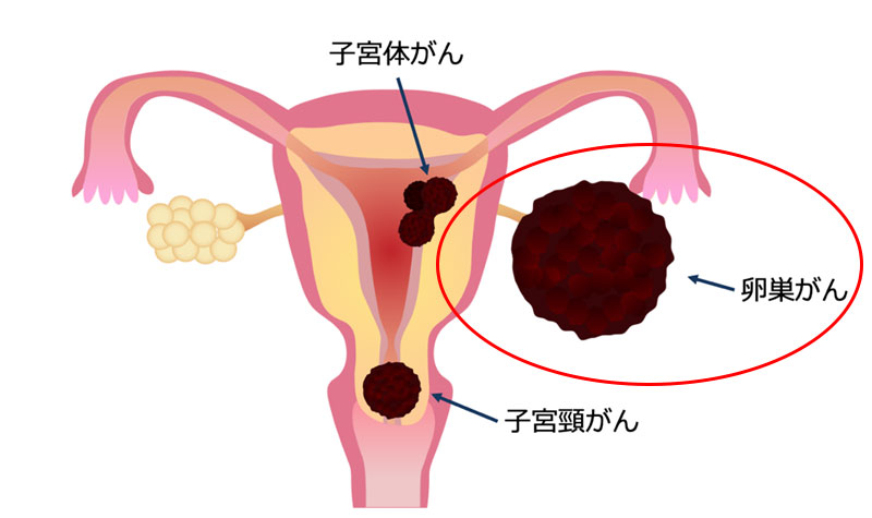 卵巣がん