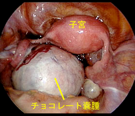 図. 腹腔鏡で見た子宮内膜症